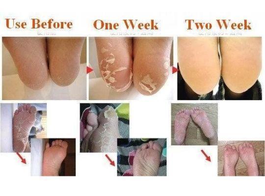 Deep Moisturizing & Exfoliating Feet Peel Mask (1 Pair Set)