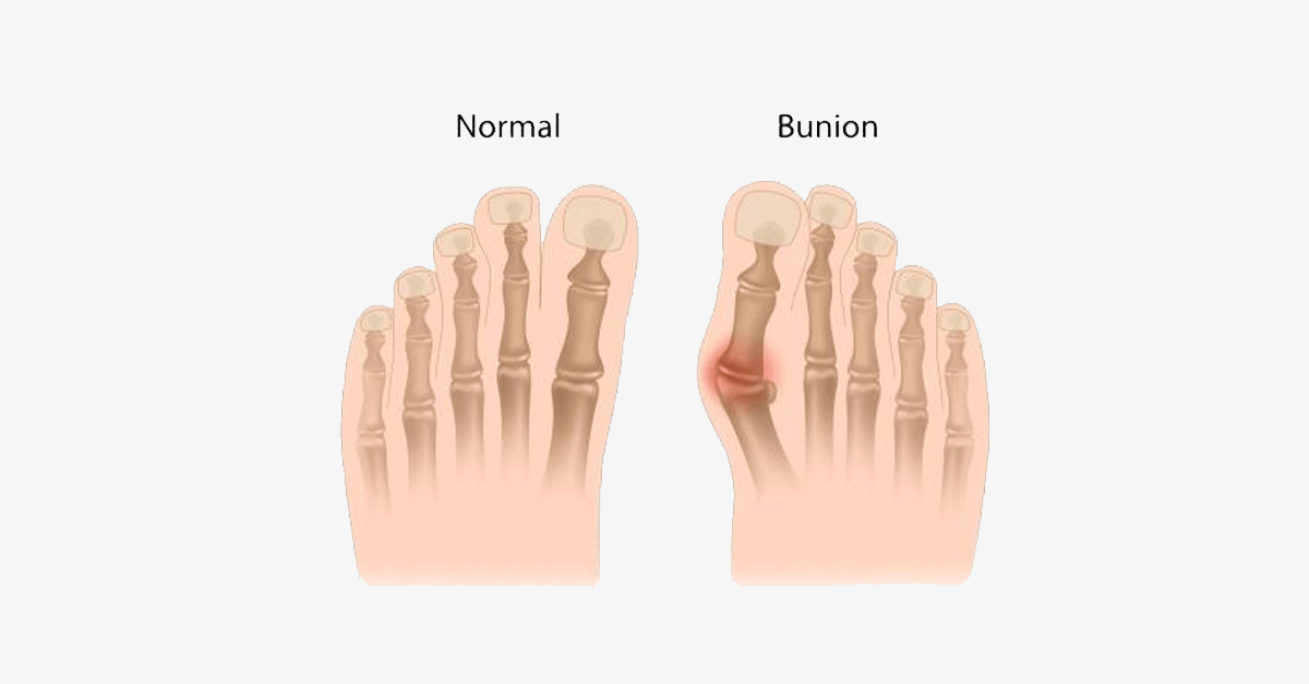 2 Pack: Comfort Healing Toe Separators and Bunion Spacers